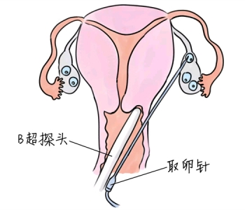 小儿退烧推拿手法 5种哈尔滨捐卵宝宝退烧按摩方法